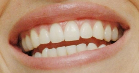 Красивые зубы и ослепительная улыбка